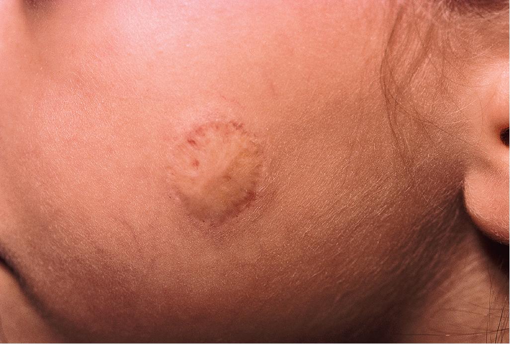 Fig. 12.21, Hemangioma, involuted. Residual scarring and atrophy are evident in this fully involuted lesion.