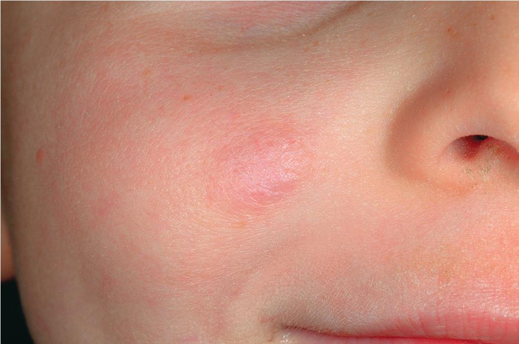 Fig. 12.22, Hemangioma, involuted. The cheek of this 4-year-old boy shows the residual fibrofatty tissue that may remain after involution.