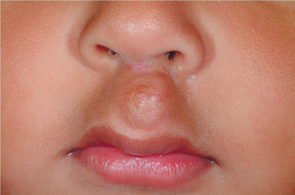 Fig. 12.23, Hemangioma, involuted. This philtrum lesion has involuted, but fibrofatty residua remain.