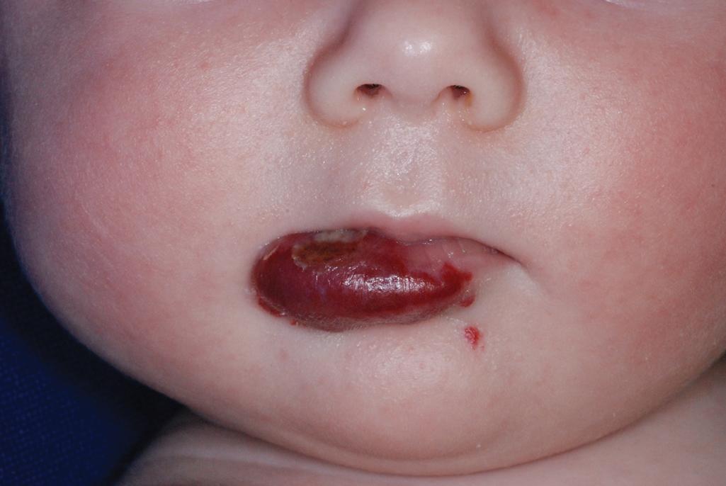 Fig. 12.25, Hemangioma, ulcerated. This lower-lip lesion ulcerated with permanent scarring the result.