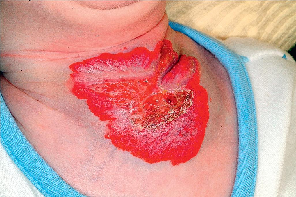 Fig. 12.27, Hemangioma, ulcerated. This anterior neck hemangioma ulcerated and healed with marked cribriform scarring.