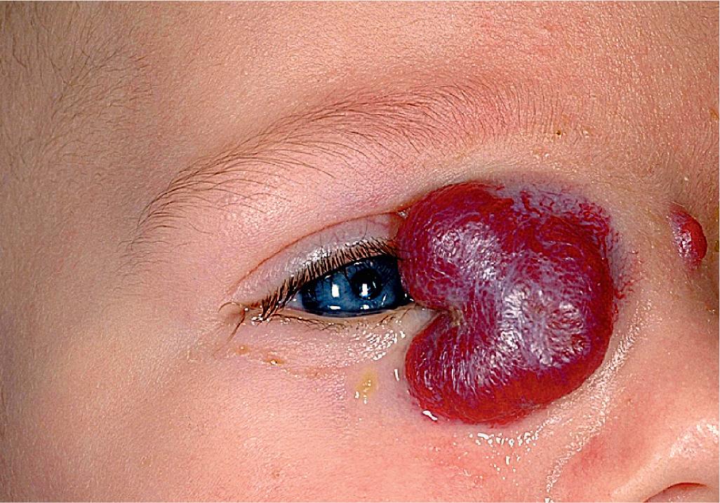 Fig. 12.28, Hemangioma, periocular. This large hemangioma was obstructing the visual axis secondary to its size and location.