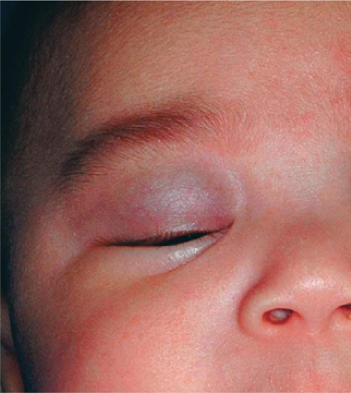 Fig. 12.29, Hemangioma, periocular. Superior eyelid hemangiomas may result in ptosis, with a risk for light-deprivation amblyopia.