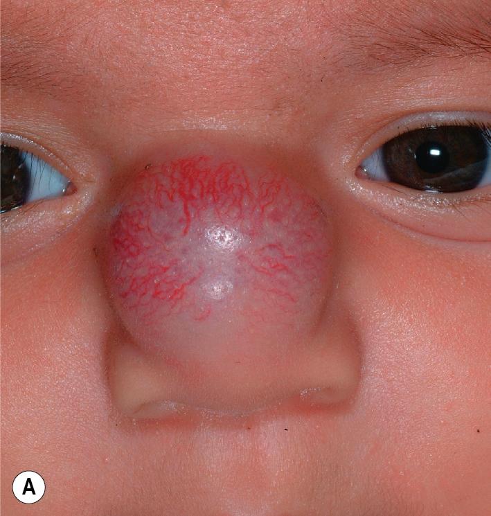 Fig. 12.30, Hemangioma, nasal bridge. This large lesion of the nasal bridge (A) results in significant bulbous distortion of the nose (B) and is likely to leave residual deformity.