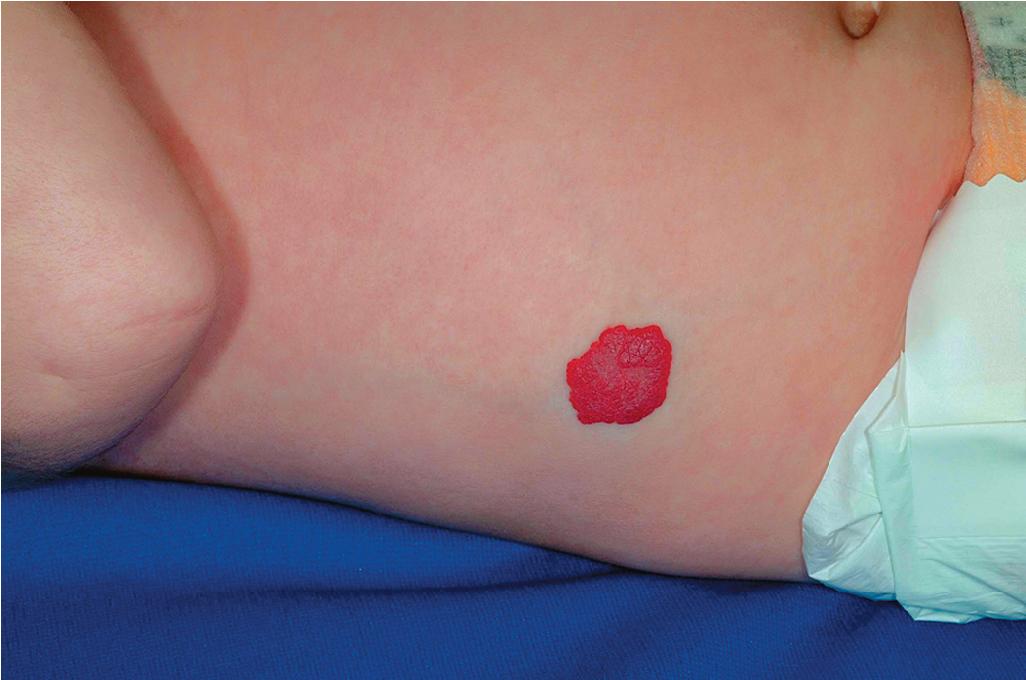 Fig. 12.3, Hemangioma, superficial: trunk.