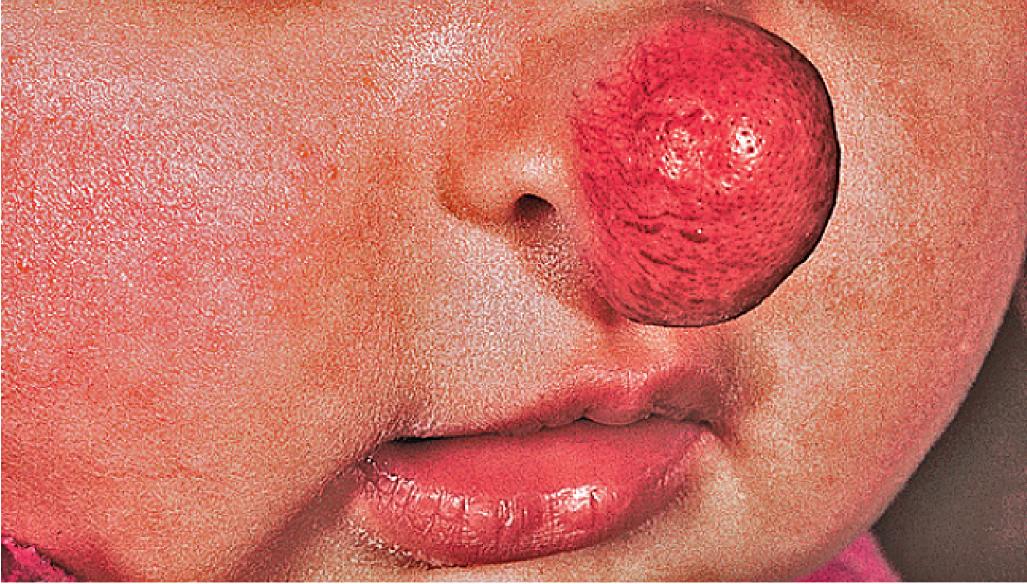 Fig. 12.32, Hemangioma, nasal tip. Large nasal tip lesions like this one may leave significant fibrofatty residua, resulting in a “Cyrano” deformity.