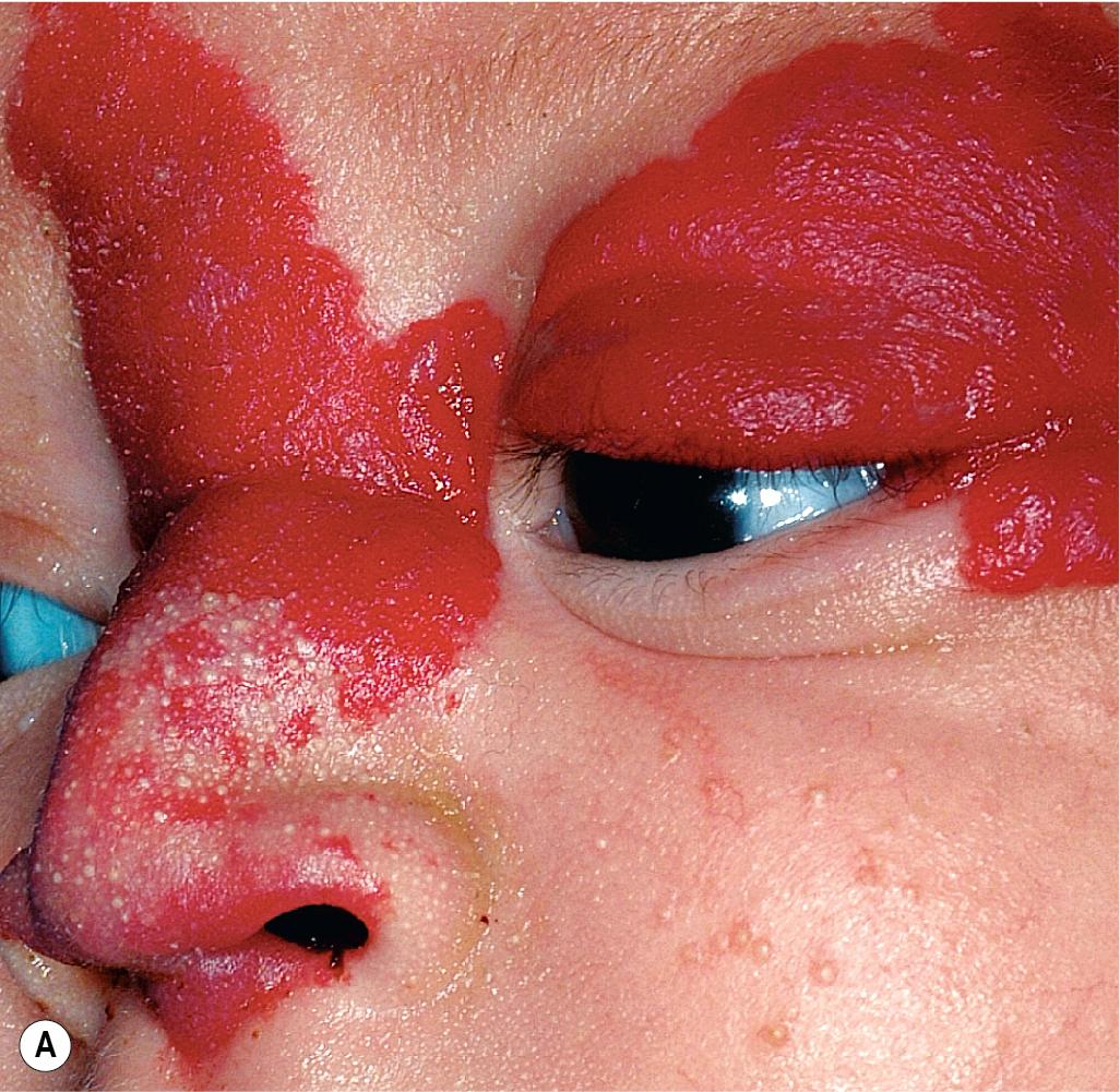 Fig. 12.33, Hemangioma, nasal crease sign. This infant girl had a segmental facial hemangioma involving the left forehead, periorbital region, glabella, nasal bridge, and nose. At 11 days after noting this linear gray atrophic crease (A) she returned to clinic with complete destruction of the nasal septum and columella and nasal collapse (B) .