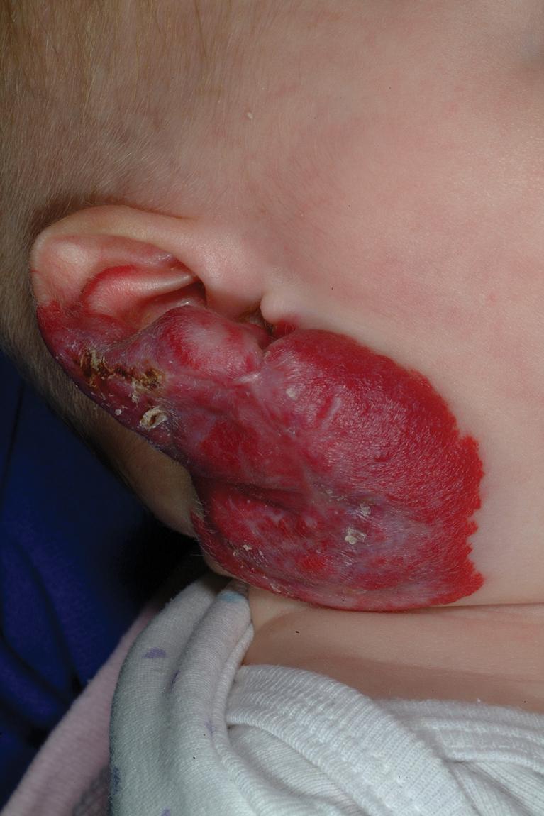 Fig. 12.34, Hemangioma, ear. This large hemangioma encompassed much of the ear as well as part of the adjacent neck. Ear hemangiomas this significant may result in permanent ear deformity and, occasionally, conductive hearing loss.