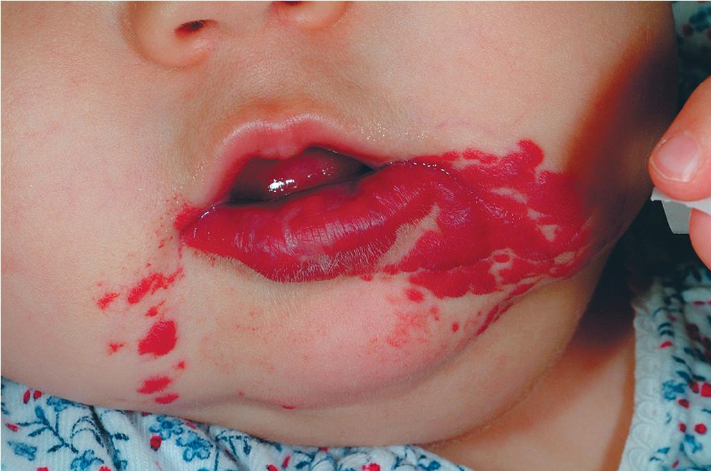 Fig. 12.35, Hemangioma, beard distribution. Lesions involving the lower lip, chin, neck, or mandibular regions have a greater risk of airway involvement, as was seen in this female infant.