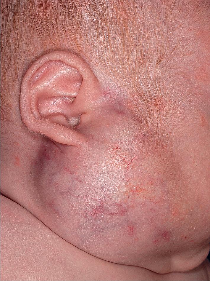 Fig. 12.36, Hemangioma, parotid. This large subcutaneous tumor with a blue hue and surface telangiectasias was characteristic for a parotid infantile hemangioma. These lesions tend to grow significantly and regress more slowly, and often require systemic therapy.