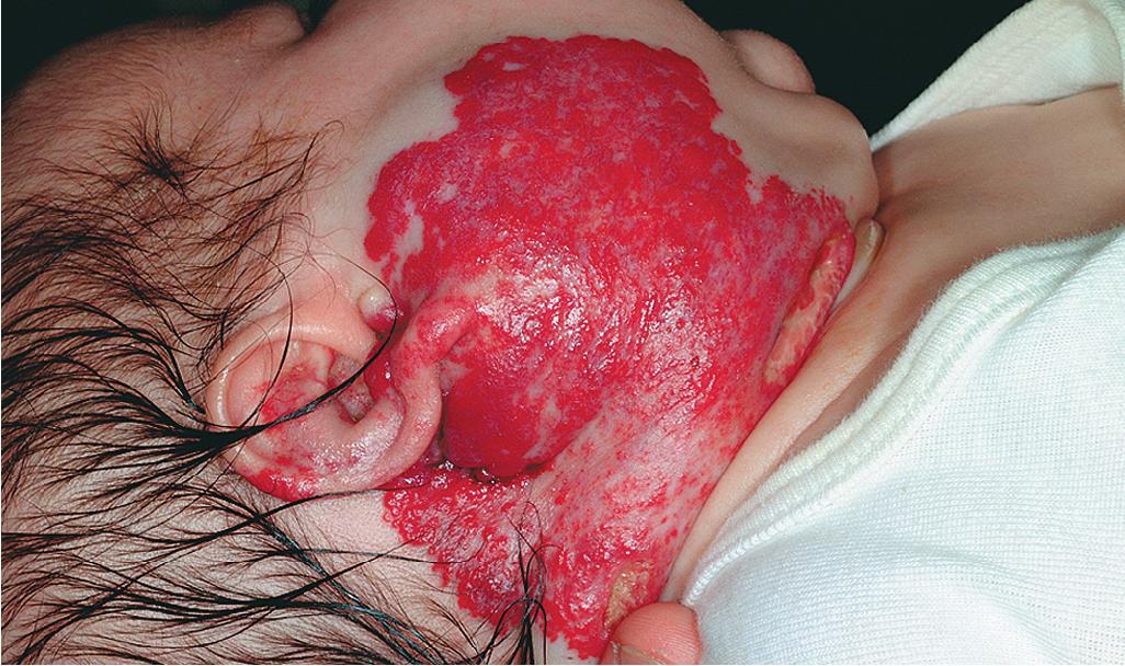 Fig. 12.40, Hemangioma, facial. Giant lesions like this one may be associated with the PHACES (posterior fossa malformations, hemangioma, arterial anomalies, cardiac defects, eye anomalies, and sternal defects) syndrome.