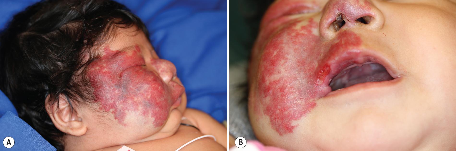 Fig. 12.41, Hemangioma with PHACES (posterior fossa malformations, hemangioma, arterial anomalies, cardiac defects, eye anomalies, and sternal defects) syndrome. This female infant presented with this large right-sided segmental facial hemangioma (A) , which developed ulceration of the right upper lip and nasal tip/columella (B) . She was found to also have intracranial arterial anomalies.