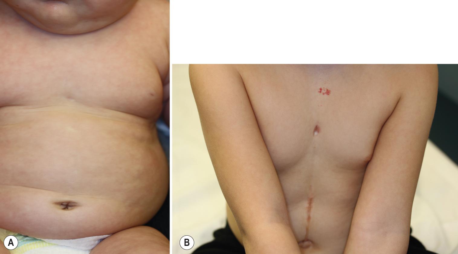 Fig. 12.42, PHACES syndrome with ventral developmental defects. (A) Sternal pit in a female infant with telangiectatic facial hemangiomas and multiple intracranial vascular anomalies. (B) Sternal pit/cleft and supraumbilical abdominal raphe in a 4-year-old female with partially involuted hemangiomas (note telangiectatic patch on upper midchest) and hypoplastic and tortuous cerebrovasculature.