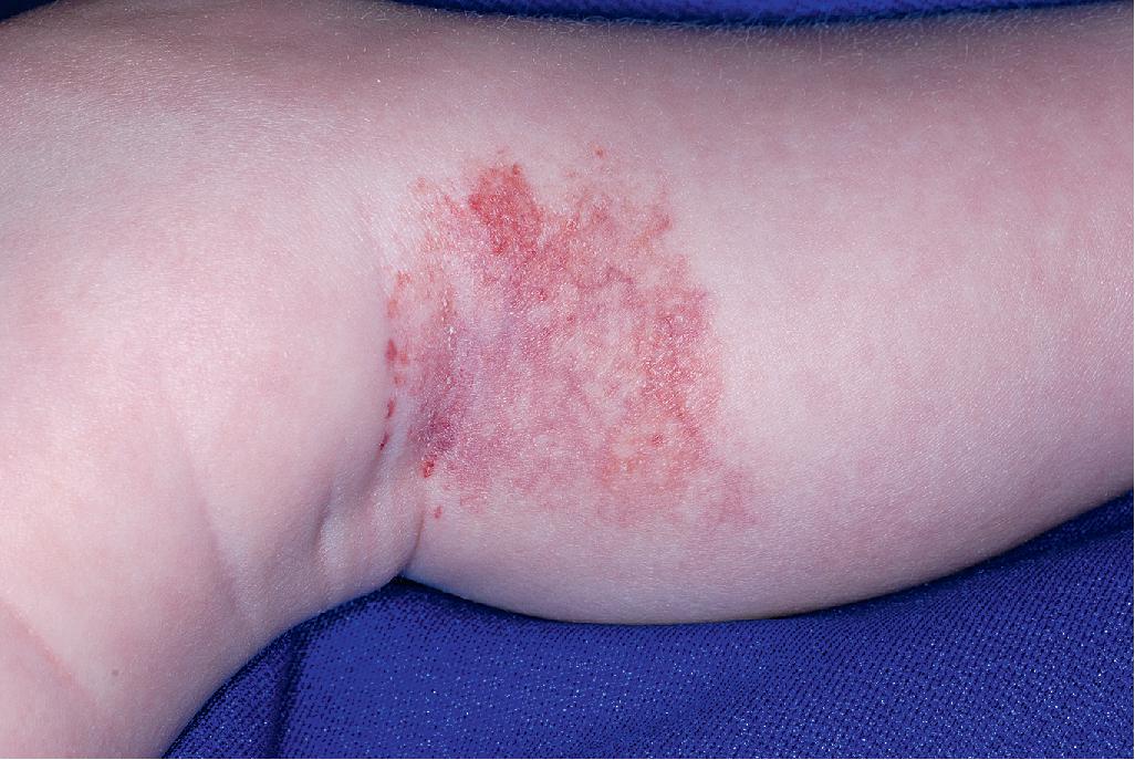 Fig. 12.44, Abortive hemangioma (infantile hemangioma with minimal or arrested growth). This telangiectatic vascular patch presented on the medial calf of this 5-month-old boy. Note the scattered brighter red vascular macules and papules around the periphery, a classic feature in some of these lesions.