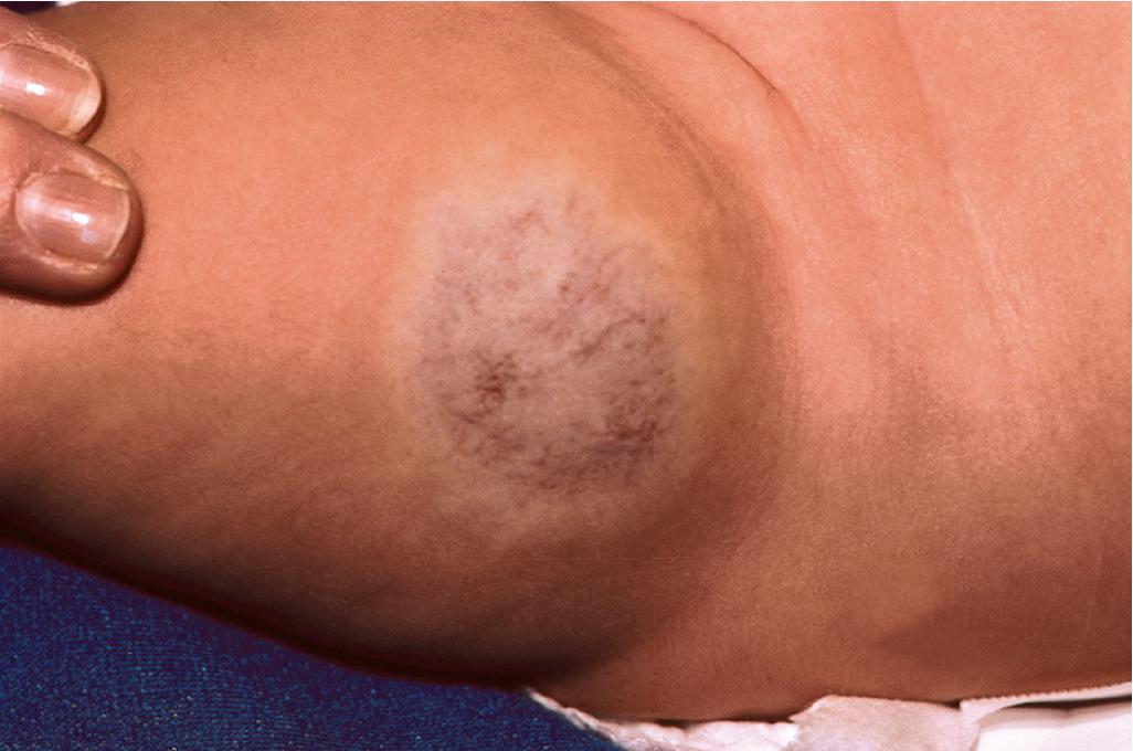 Fig. 12.45, Hemangioma, noninvoluting congenital. Characteristic features include prominent surface telangiectasias and a peripheral rim of pallor.