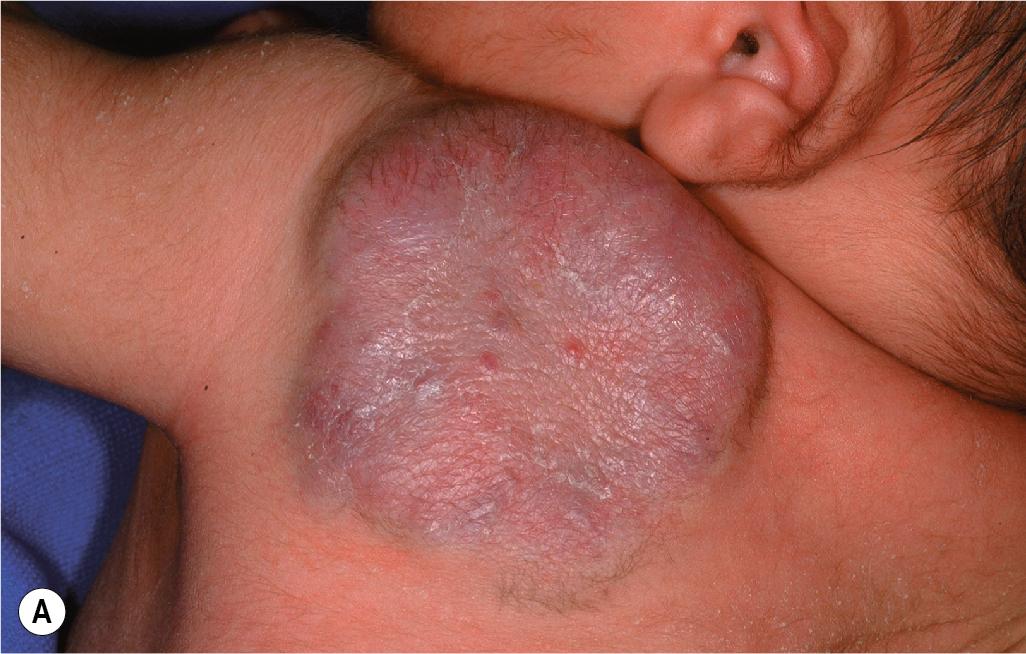 Fig. 12.46, Hemangioma, rapidly involuting congenital. This hemangioma was fully formed at birth (A) and involuted completely by 1 year of age (B) .