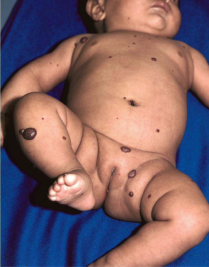 Fig. 12.48, Hemangiomatosis, diffuse. This infant had variably sized lesions and liver hemangiomatosis.