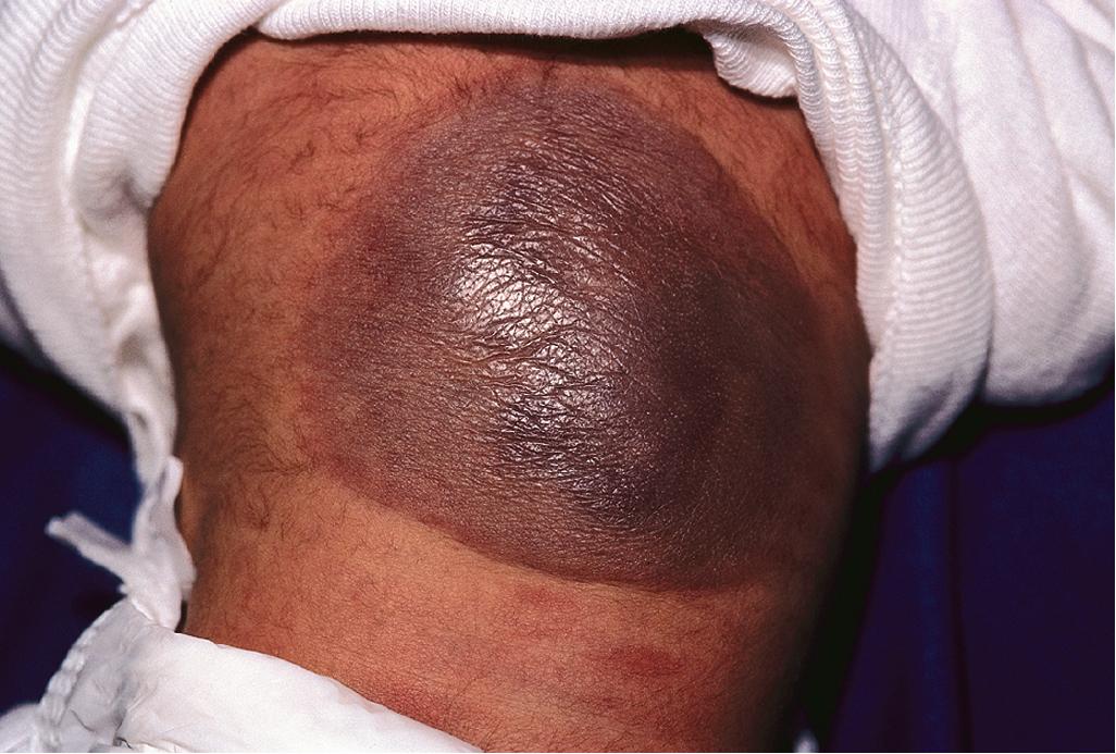 Fig. 12.50, Kaposiform hemangioendothelioma. These tumors are characteristically deep purple in color and may be associated with Kasabach–Merritt phenomenon.