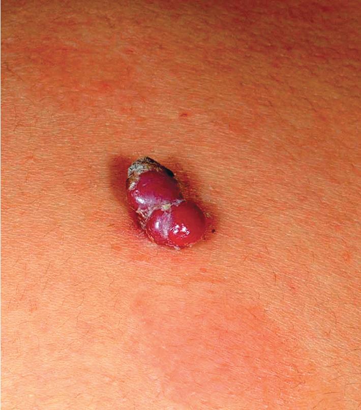 Fig. 12.54, Pyogenic granuloma. This lesion is multilobulated.