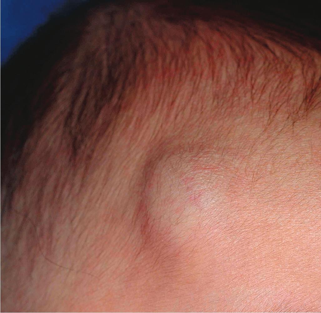 Fig. 12.7, Hemangioma, deep. Note the subtle blue hue and surface telangiectasias.