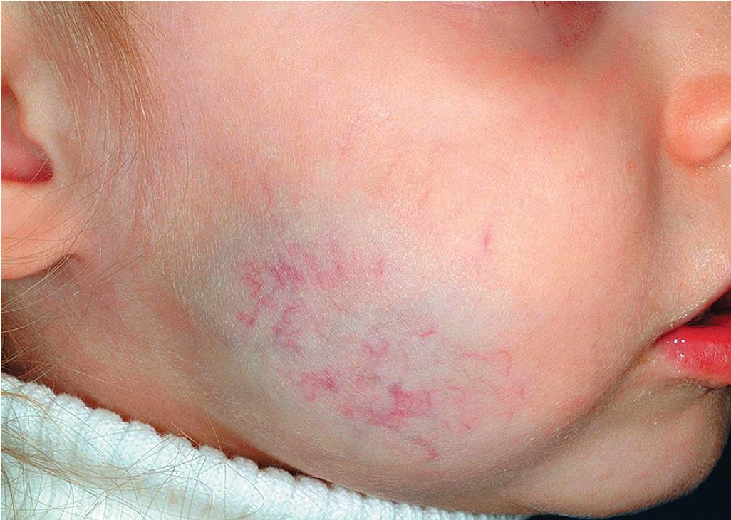 Fig. 12.8, Hemangioma, deep. This larger lesion shows the characteristic deep-blue hue and surface telangiectasia.