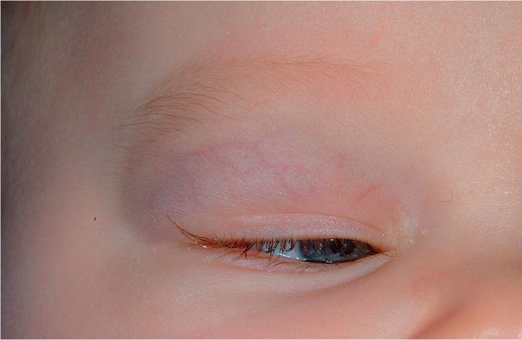Fig. 12.9, Hemangioma, deep. This small, deep lesion resulted in mechanical ptosis, necessitating therapy out of concern for light-deprivation amblyopia. Note the overlying surface telangiectasias.