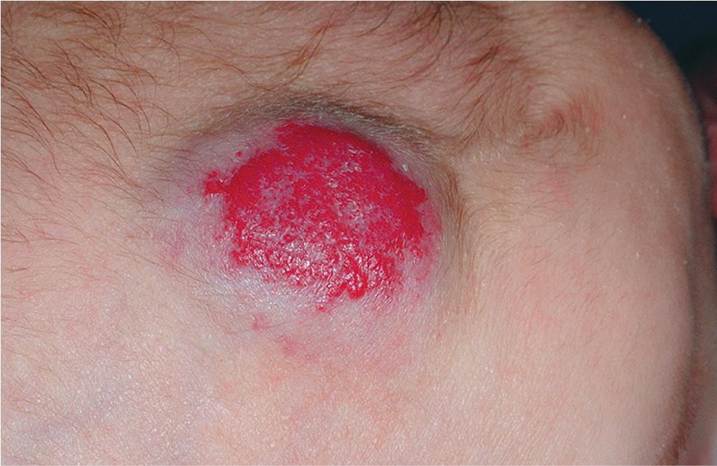 Fig. 12.10, Combined hemangioma. Note the larger, deep component and the bright red, superficial component of this combined lesion.