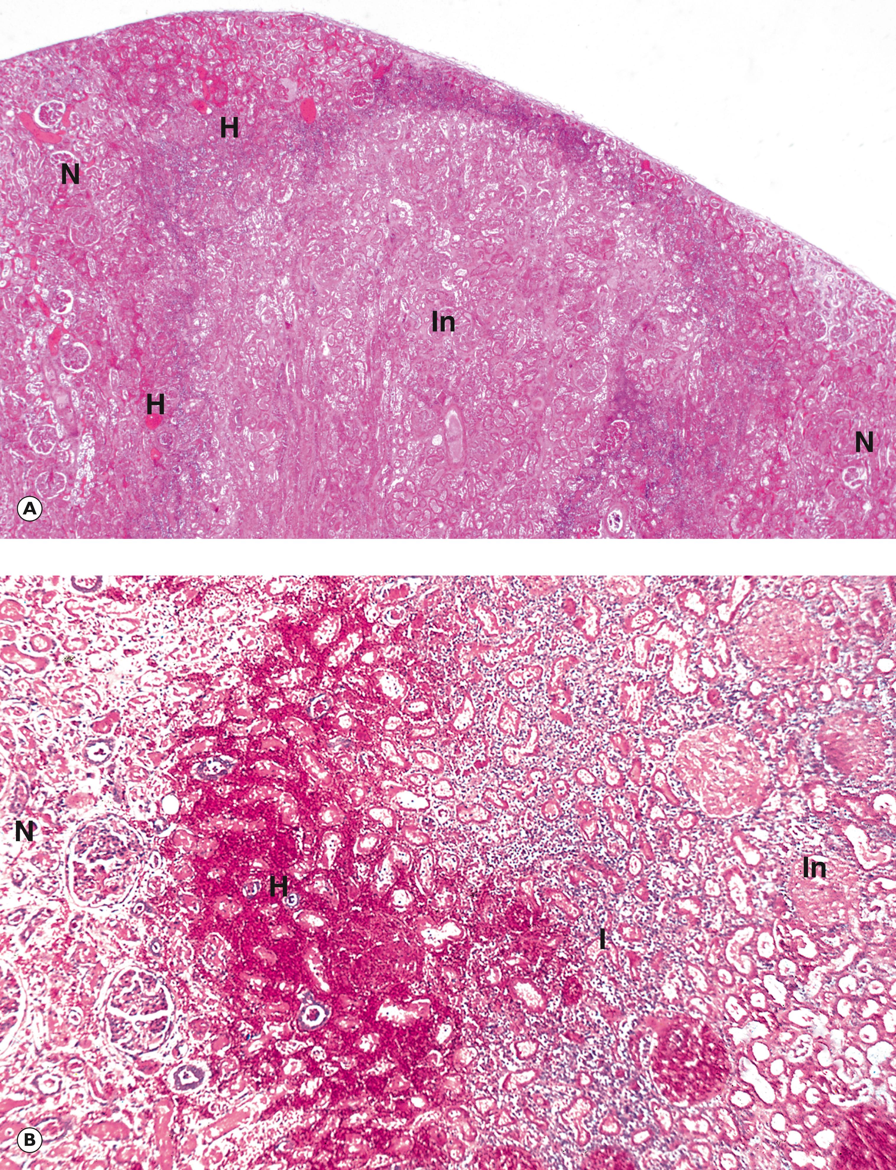 Fig. 10.1, Renal infarction. (A) Early infarct (LP); (B) margin of infarct (MP); (C) old renal infarct (MP).