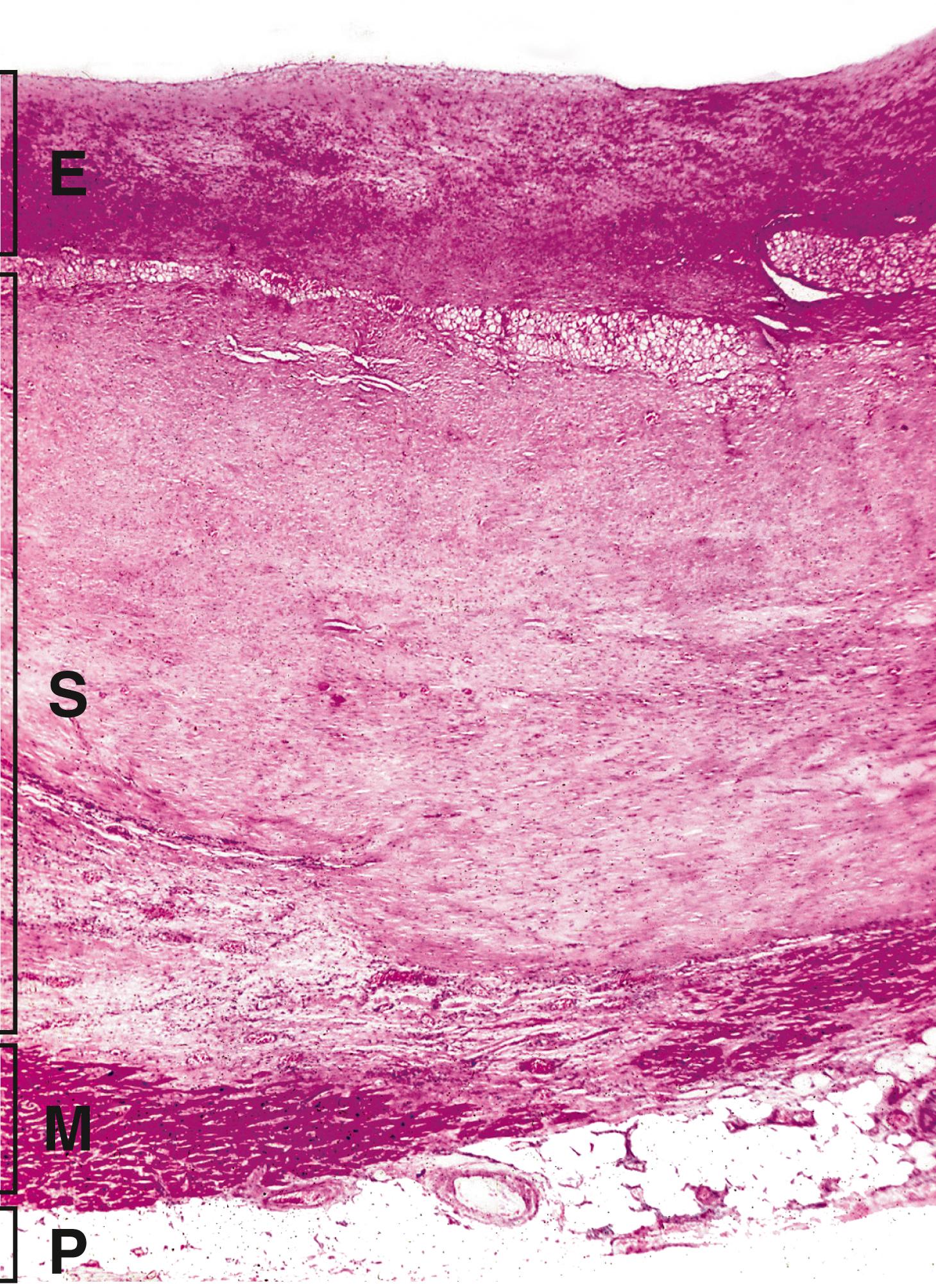 Fig. 10.3, Old myocardial infarct: full-thickness scar (LP).