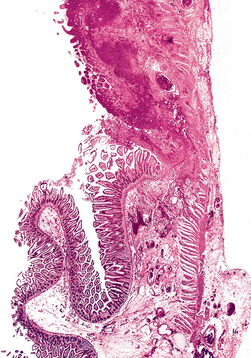 Fig. 10.5, Venous infarction of bowel following volvulus (LP).