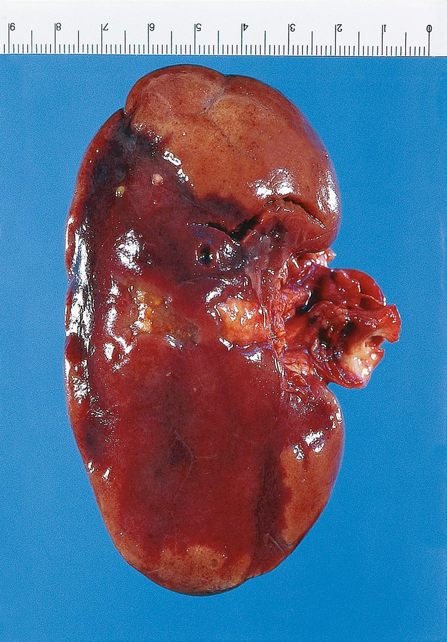 E-Fig. 10.1 G, Renal infarction. In this image, we can see wedge-shaped yellow areas of infarction within the kidney. These areas of infarction were caused by thrombosis of a branch of the renal artery. The thrombus was a complication of atherosclerosis of the renal artery.