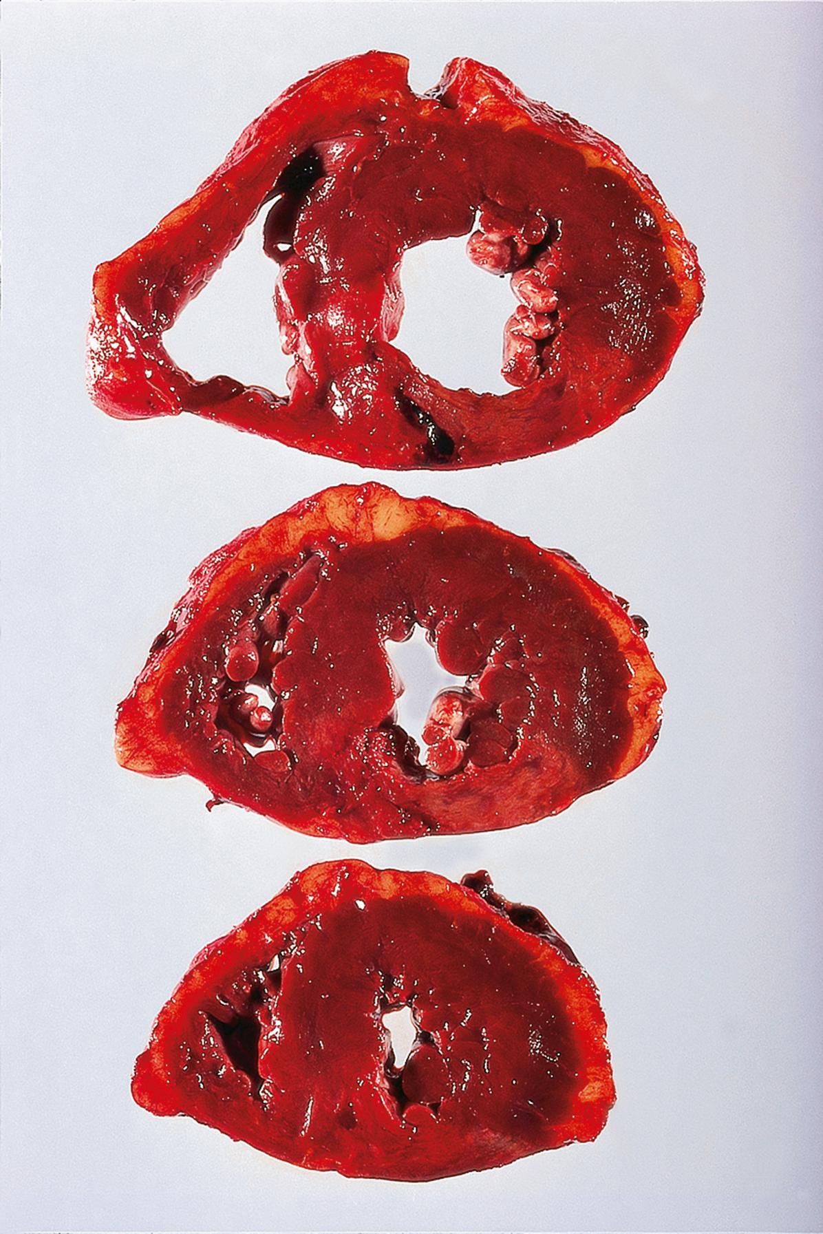 E-Fig. 10.2 G, Infarction. This is a slice of the ventricles taken just below the level of the papillary muscle. Within the posterior wall of the left ventricle, there is an area of yellow softening representing necrosis of the cardiac myocytes. This is the typical appearance of a posterior myocardial infarction. In this image, the infarct is transmural.