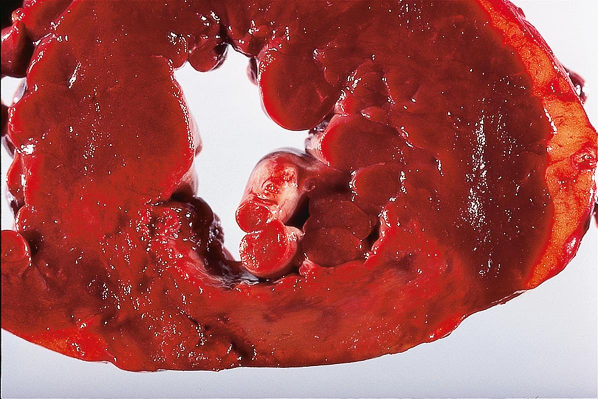 E-Fig. 10.3 G, Infarction. In this close up view of a posterior myocardial infarction as seen in E-Fig. 10.2 G s, the yellow softening is more readily seen. Note that the papillary muscles have also undergone infarction. When this occurs, the posterior leaflet of the mitral valve, which attaches to the papillary muscles at the posterior aspect of the left ventricle, is rendered incompetent.