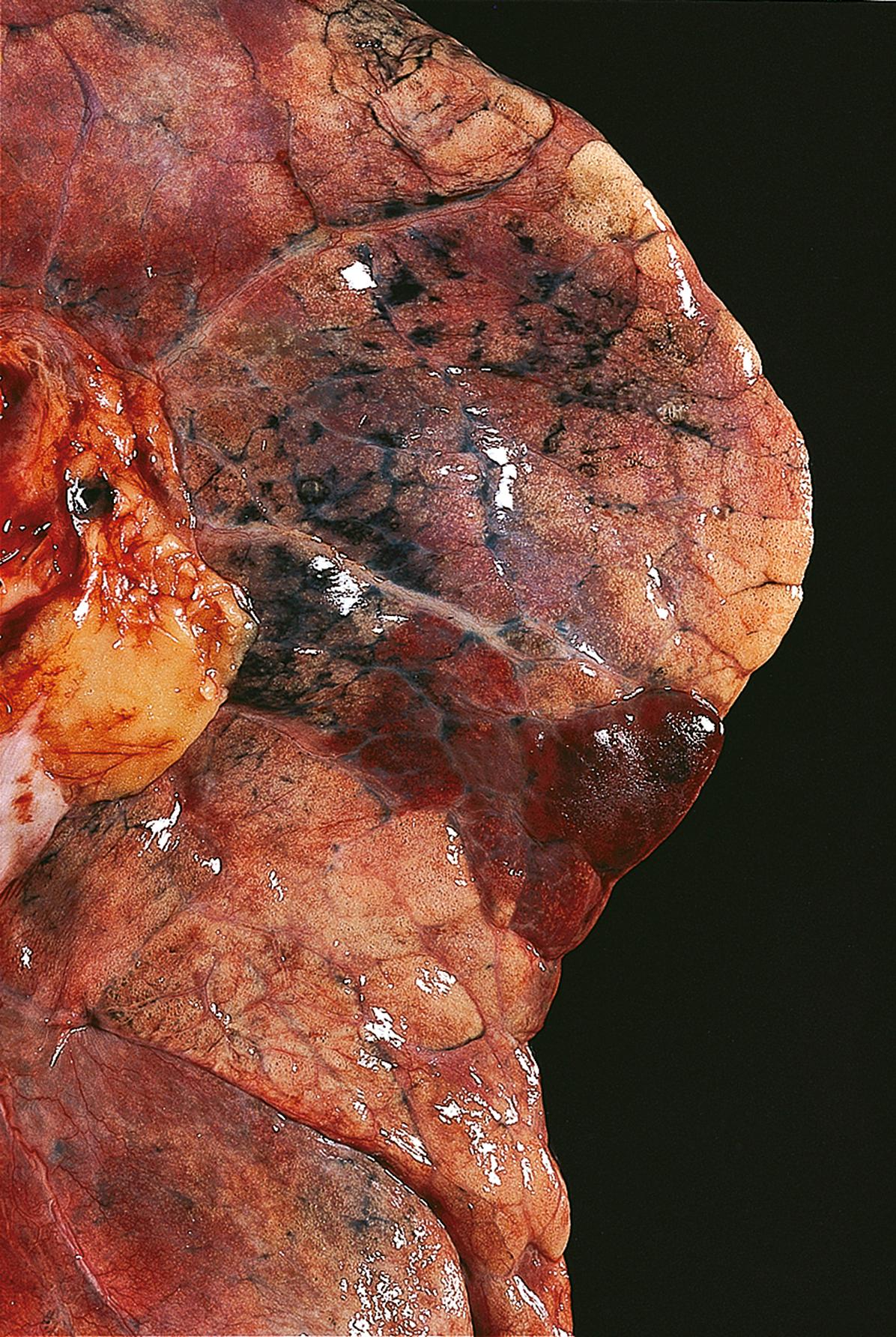 E-Fig. 10.4 G, Pulmonary infarction due to thrombo-embolism. This lung contains a wedge-shaped area of infarction caused by a thrombo-embolism. This area appears haemorrhagic and is firm and elevated above the level of the adjacent normal lung tissue.