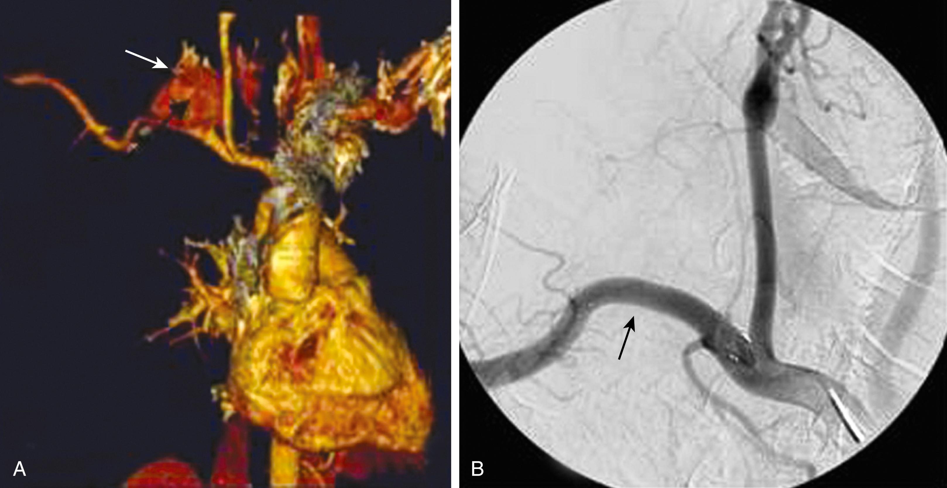 Figure 145.1, ( A ) Three-dimensional reconstruction computed tomographic angiography image in a patient with a polymicrobial posttraumatic false aneurysm of the right subclavian artery caused by repeated percutaneous cervical injection of illegal narcotics (arrow) . ( B ) Treatment with a covered stent graft for control of hemorrhage (arrow) . Adjuvant therapy included open debridement and irrigation along with intravenous antimicrobial therapy.