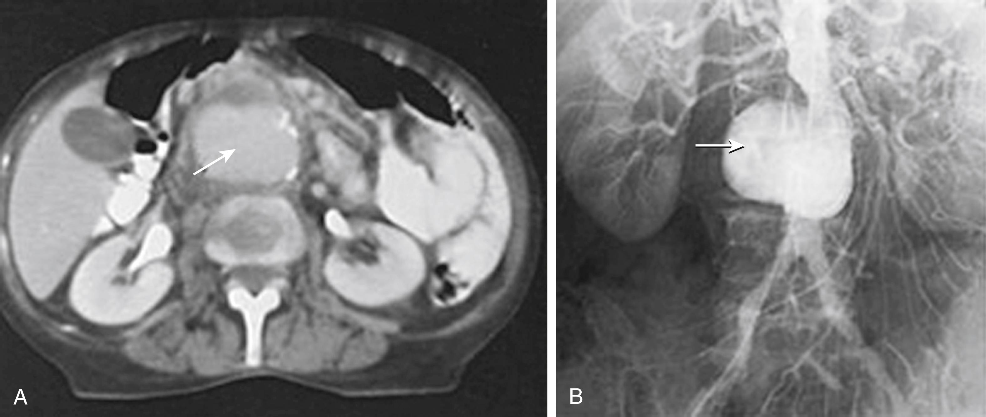 Figure 145.2, Diagnostic radiology studies of a patient with Salmonella infection of a preexisting small atherosclerotic aneurysm. ( A ) Contrast-enhanced computed tomography scan showing a saccular aneurysm with calcification (arrow) . ( B ) Transfemoral aortogram showing a saccular atherosclerotic infrarenal aneurysm (arrow) .
