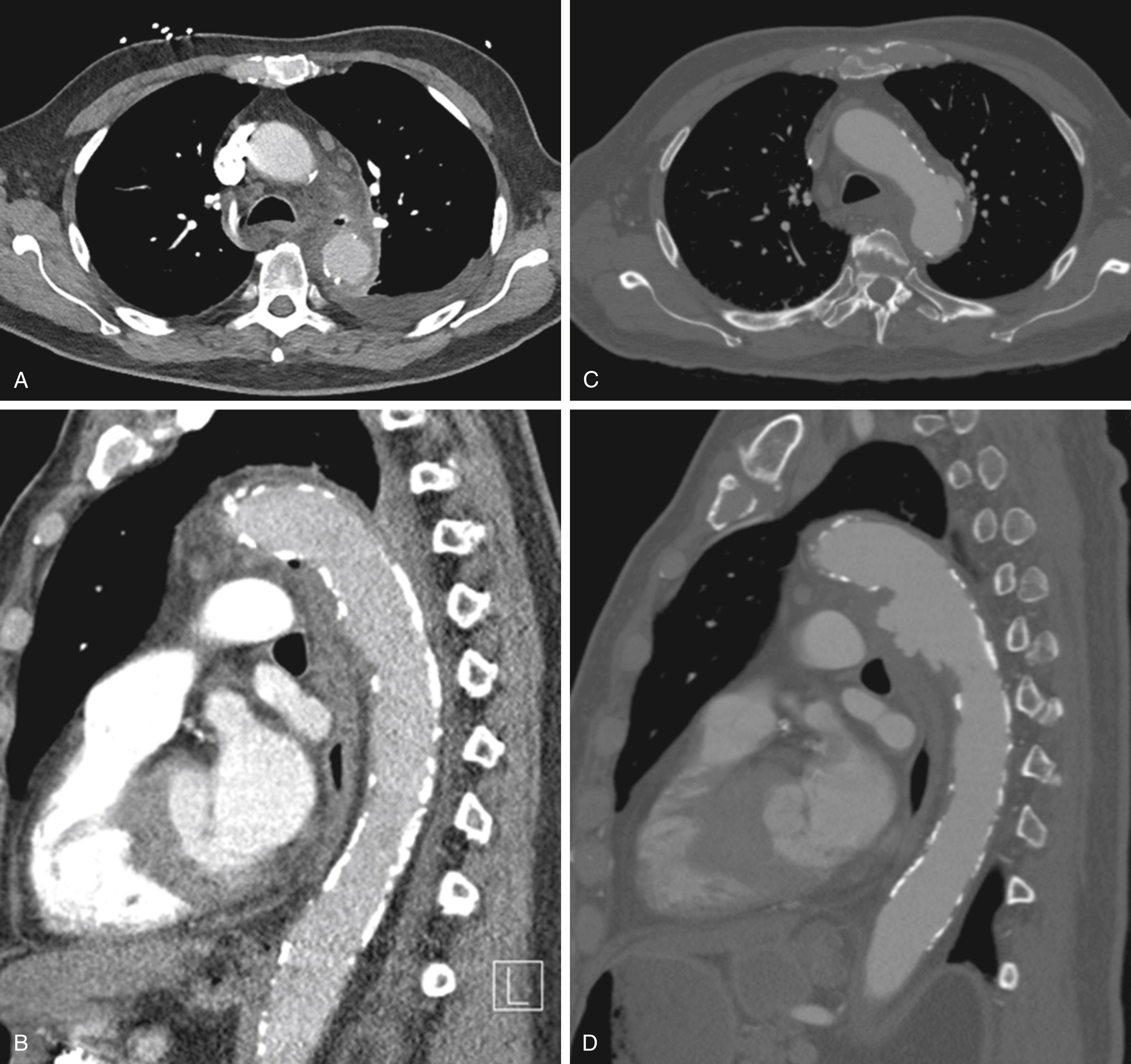 Figure 145.3, Clostridium septicum aortitis of the proximal descending thoracic aorta. ( A and B ) Proximal descending thoracic aorta with periaortic gas formation, and thickened wall. ( C and D ) Interval computed tomographic angiography in 10 days showing rapid enlargement of the aortic pseudoaneurysm. Patient underwent open aortic debridement via posterolateral thoracotomy, and in situ reconstruction.