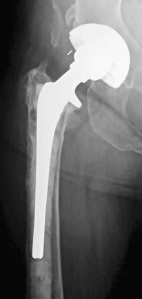 Fig. 105.1, Plain radiograph of a total hip arthroplasty with a cementless acetabular component and a cemented femoral component demonstrating significant osteolysis and implant loosening of the femoral component at 21 months postoperatively. This is highly suggestive of deep infection.