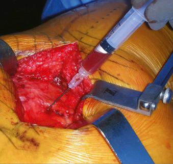 Fig. 105.2, Technique for aspirating synovial fluid from the hip joint. The iliotibial band has been incised and is retracted. An 18-gauge spinal needle attached to a 10-mL syringe is used to aspirate fluid through the capsule before the capsulotomy is performed. This technique allows for easy access to the synovial fluid while minimizing potential contamination that can occur when aspirated through the skin or multiple layers of tissue.