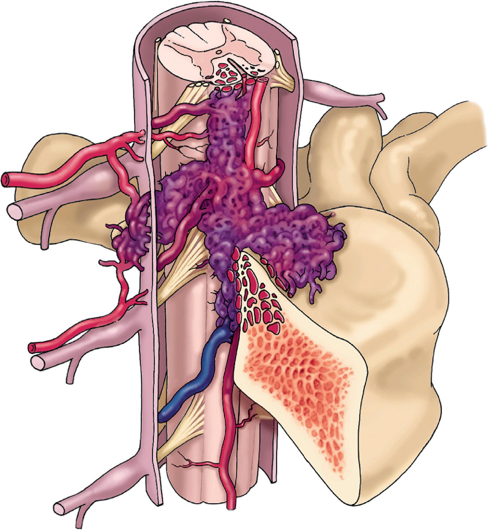 From McDougall CG, Deshmukh VR, Fiorella DJ, Albuquerque FC, Spetzler RF. Endovascular techniques for vascular malformations of the Spinal Axis. Neurosurg Clin N Am. 2005;16(2):395–410.