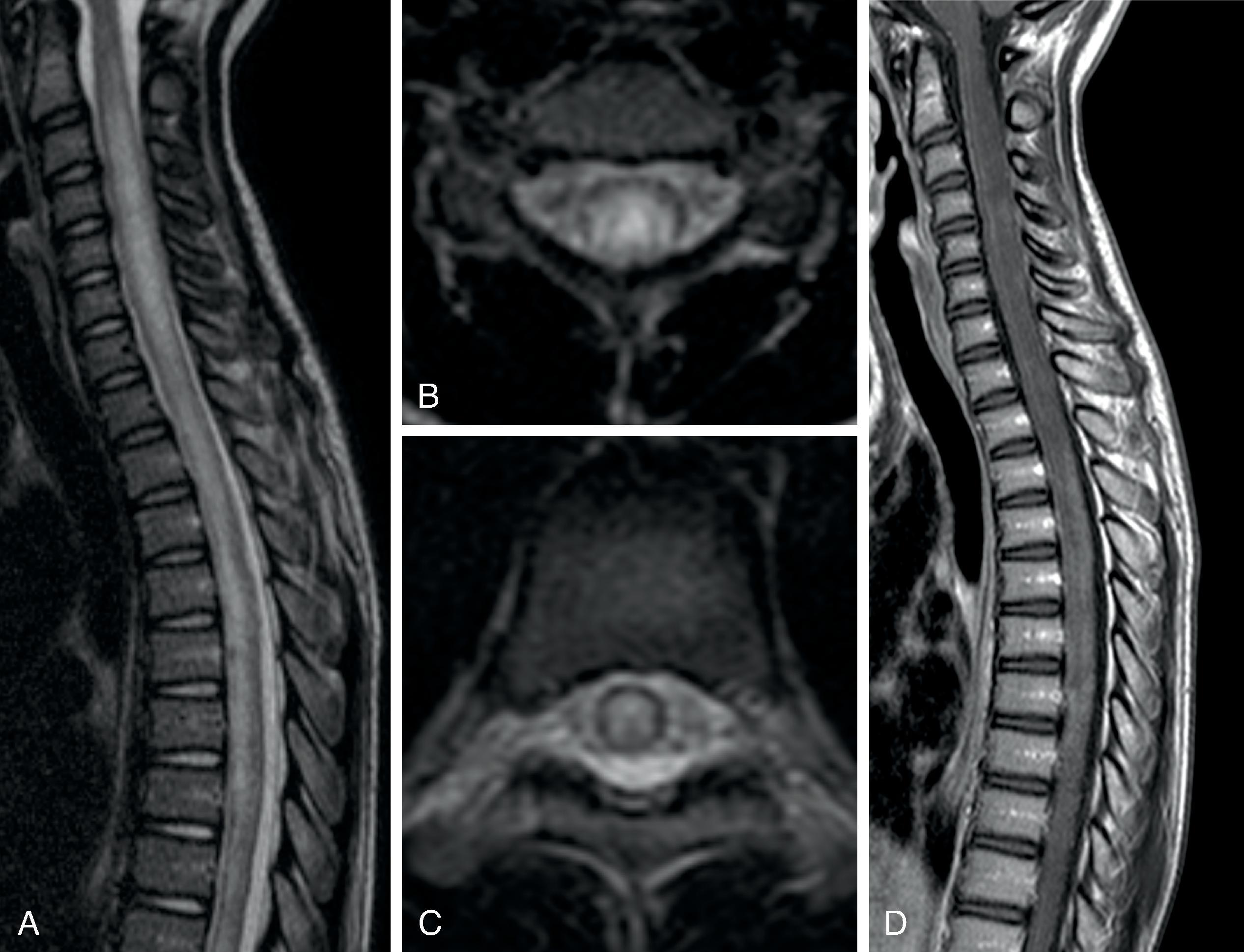 Fig. 18.2, Transverse Myelitis. A 10-year-old with lower extremity weakness, urinary retention, and T6 level decreased light touch and pinprick sensation but intact position and vibratory sensation. CSF demonstrated elevated white blood cell (WBC) count (124 cells/mm 3 ), normal glucose, and elevated total protein (171 mg/dL). (A to C) Sagittal and axial T2W and (D) sagittal T1W+C images demonstrate a longitudinally extensive minimally expansile T2W hyperintense spinal cord abnormality involving majority of the cross section of the spinal cord with mild patchy areas of enhancement.