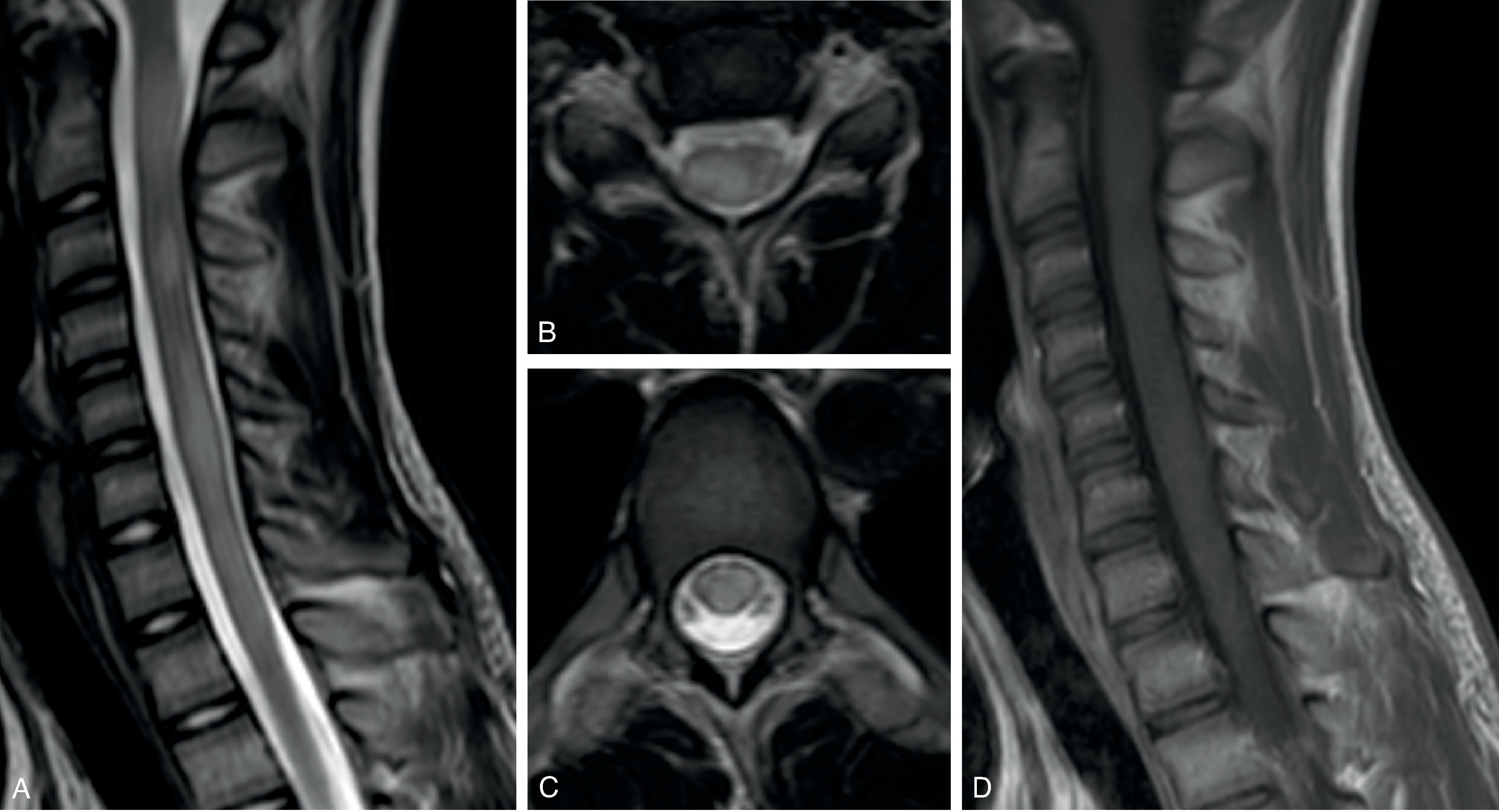 Fig. 18.4, Anti-MOG Myelitis. A 15-year-old with numbness in the toes and hands progressing to upper and lower extremity weakness. (A to C) Sagittal and axial T2W images demonstrate multiple short and a longitudinally extensive minimally expansile T2W hyperintense spinal cord lesions involving gray and white matter without enhancement.