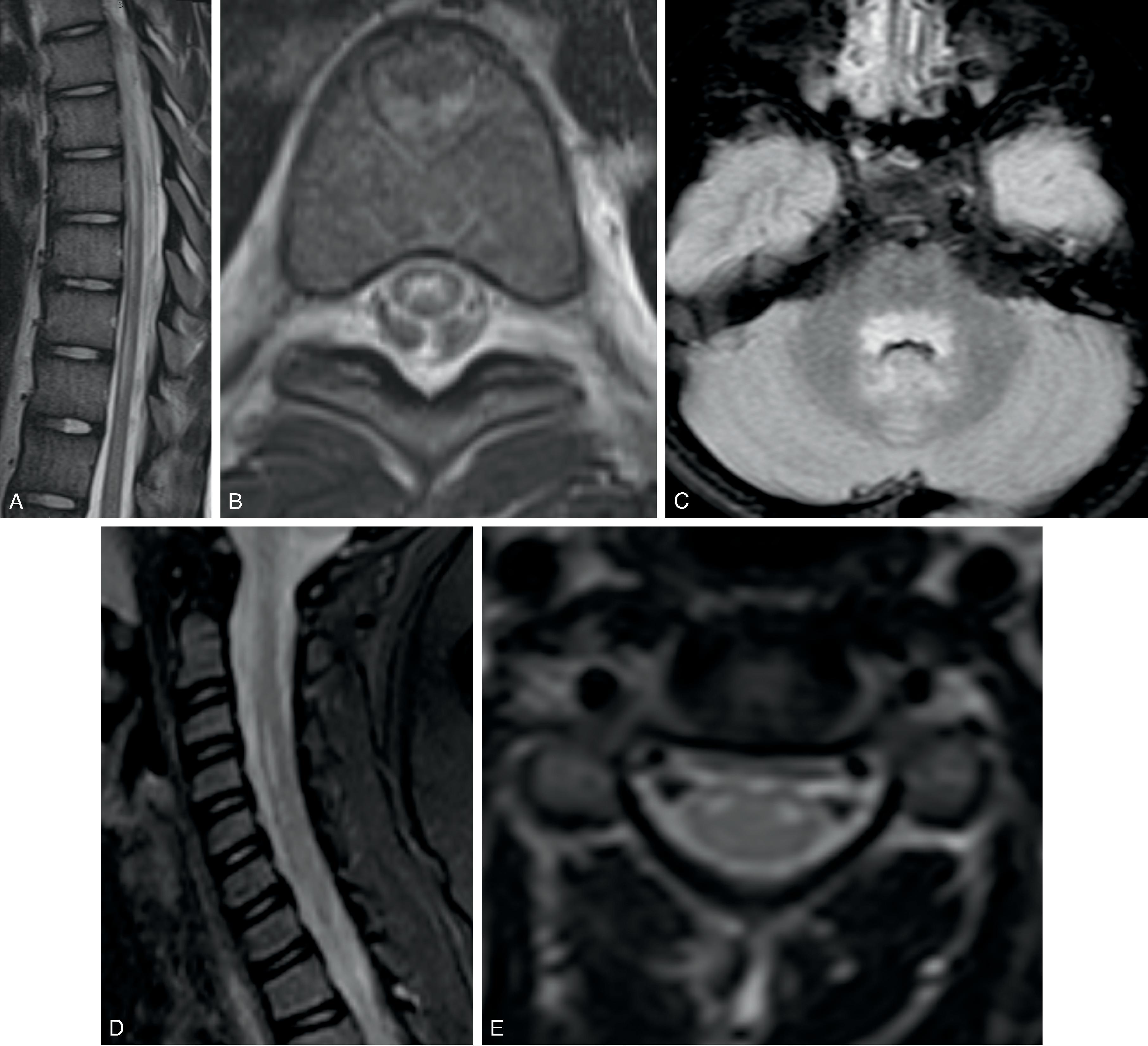 Fig. 18.5, Acute Flaccid Myelitis. (A to C) A 17-year-old with acute-onset flaccid lower extremity weakness. (A and B) Sagittal and axial T2W images demonstrate longitudinally extensive nonexpansile linear T2W hyperintense spinal cord abnormality in the central gray matter of the thoracic spinal cord without enhancement (not shown). (C) Axial FLAIR image demonstrates FLAIR hyperintense signal in the dorsal pons. (D and E) Acute onset of upper extremity weakness in a child. Sagittal and axial T2W images demonstrate short segment T2W hyperintensity limited to the anterior horns of the central gray matter.