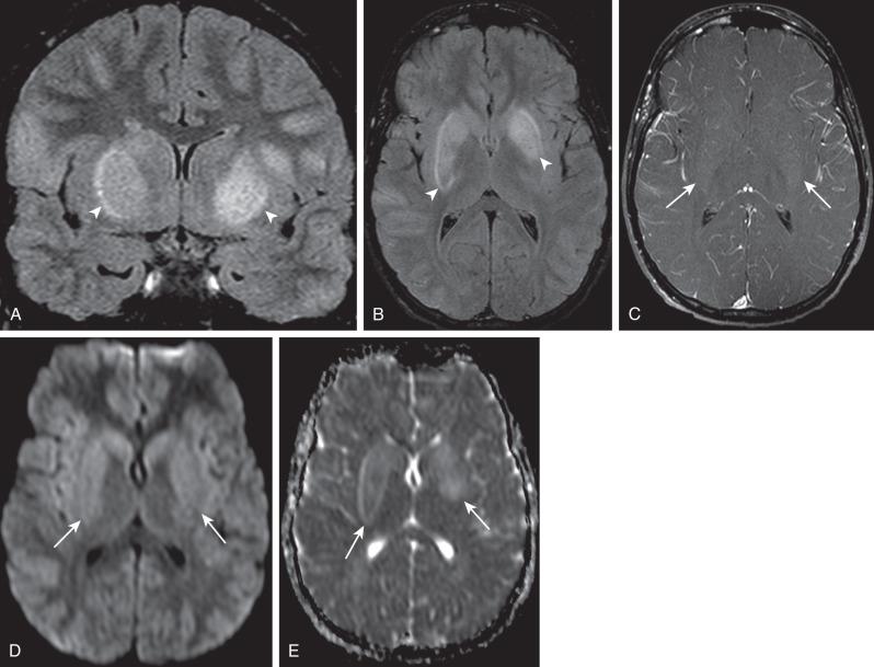 e-Figure 34.1, West Nile virus.