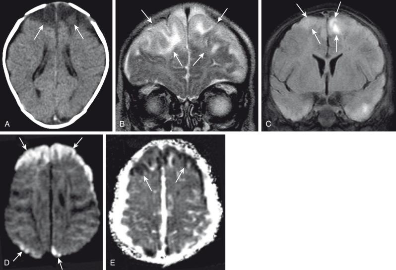 Figure 34.11, Group B streptococcus (GBS) meningitis.