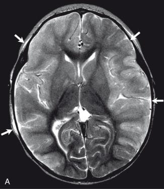 Figure 34.12, Pneumococcal meningitis with infarctions.