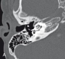 Figure 34.15, Labyrinthitis ossificans.