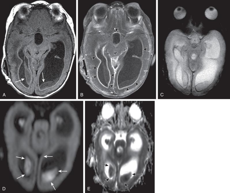 e-Figure 34.13, Ventriculitis.