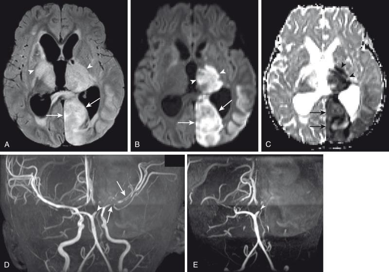 Figure 34.16, Tuberculous (TB) meningitis.