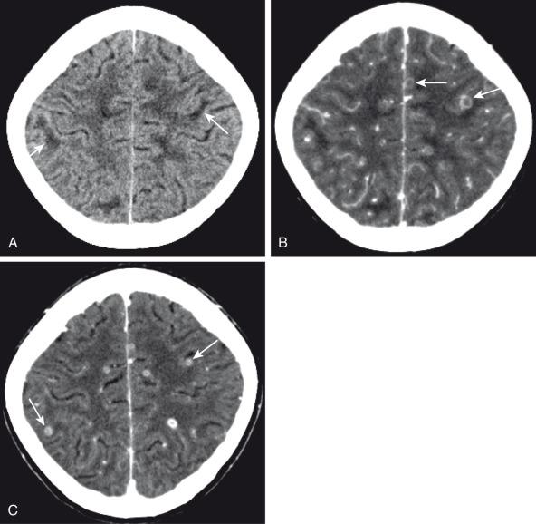 Figure 34.17, Tuberculosis and microabscesses.